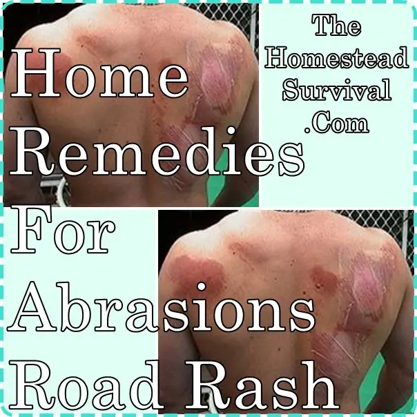 Home Remedies For Abrasions Road Rash