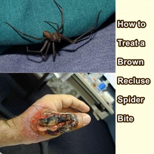 How to Treat a Brown Recluse Spider Bite - The Homestead Survival