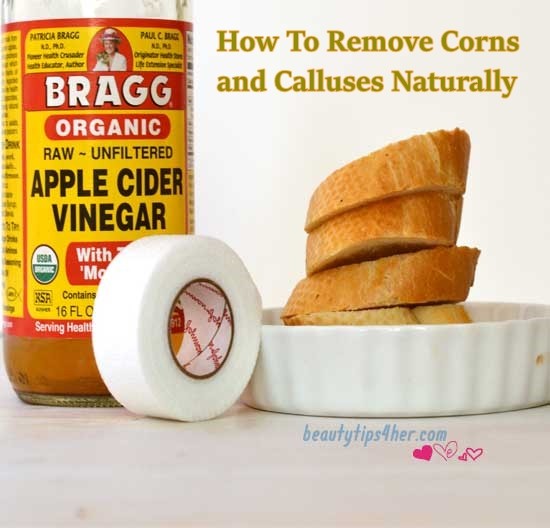 How To Remove Corns and Calluses Naturally