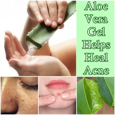 Aloe Vera Gel Helps Heal Acne