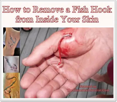 How to Remove a Fish Hook from Inside Your Skin