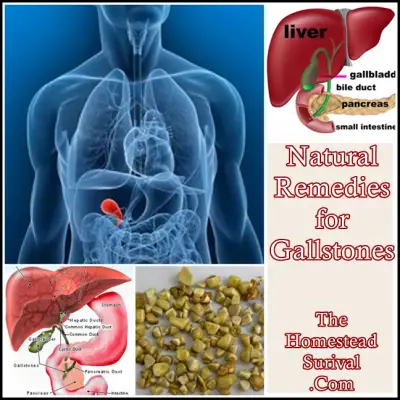 Natural Remedies for Gallstones