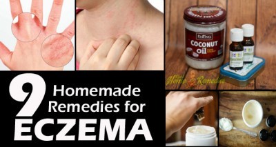 Natural Home Remedies for Healing Eczema