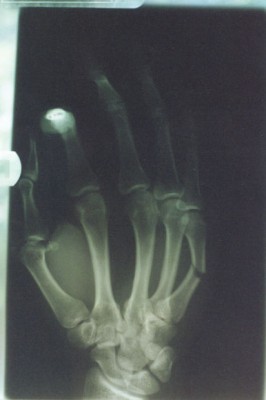 Broken Bones And Dislocated Joints - What To Do