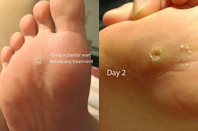 How To Get Rid Of A Plantar Wart
