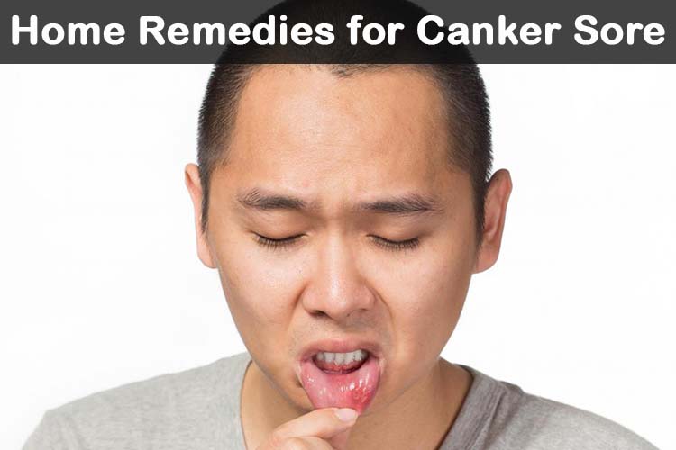 Heal Canker Sores The Natural Way