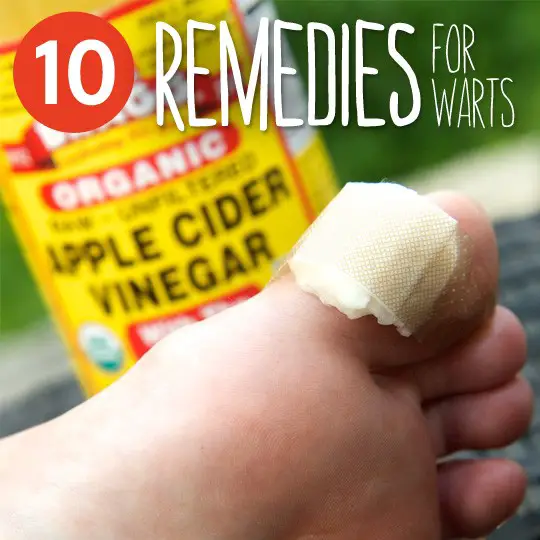Old Fashioned Home Remedies Wart Removal