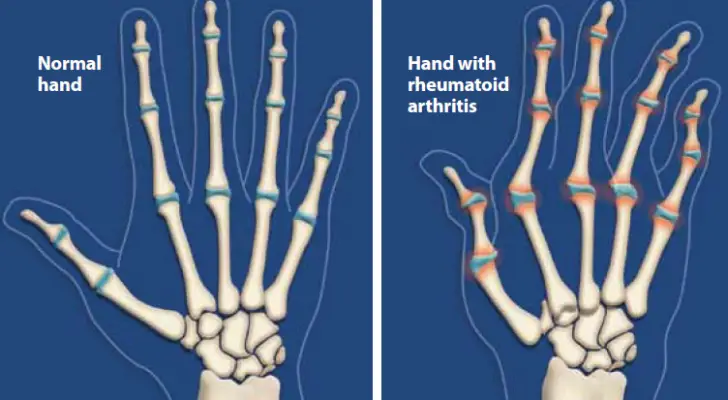 Ways To Put Rheumatoid Arthritis Into Remission