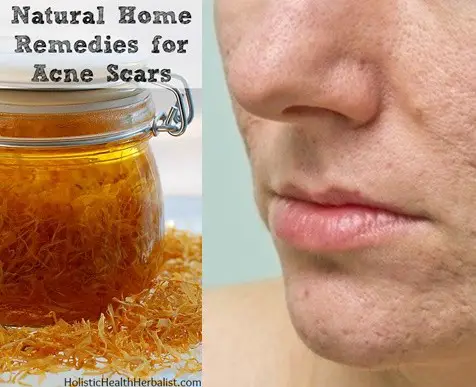 Effective Home Remedies for Old Acne Scars