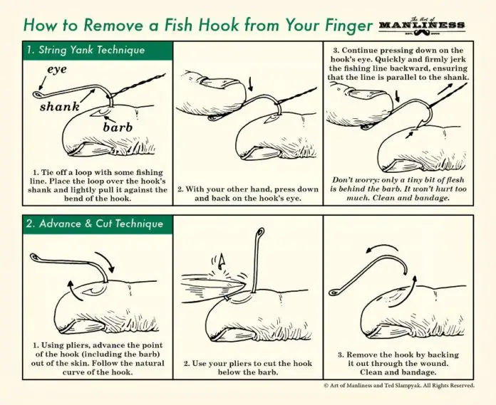 How to Remove a Impaled Fish Hook from Your Finger