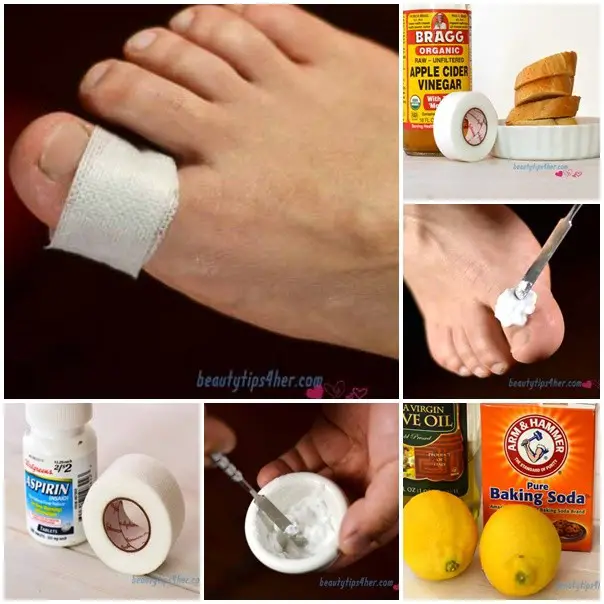 Natural Remedies to Remove Corn and Calluses from Feet