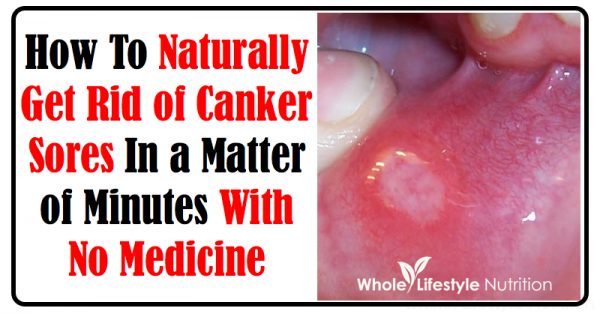 How To Heal A Canker Sore Fast
