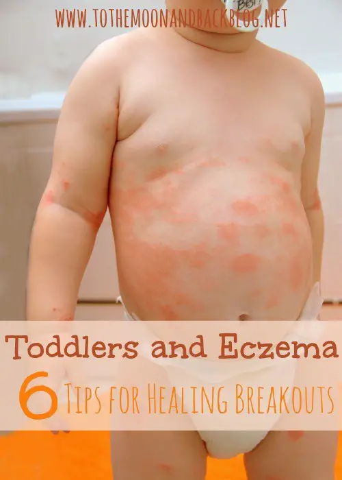 Tips for Healing Eczema Breakouts in Children