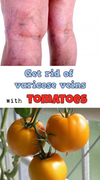Tomato Remedy For Varicose Veins