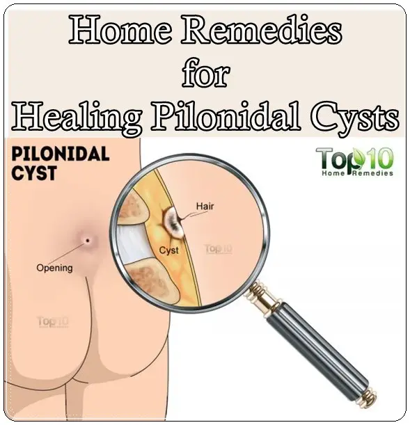 Home Remedies for Healing Pilonidal Cysts
