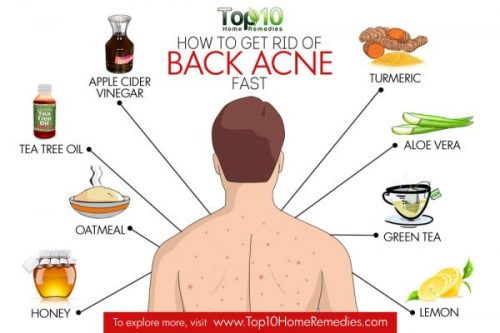 How to Get Rid of Back Acne with Home Remedies