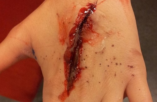 Using a Straight Needle To Put Stitches a Deep Wound