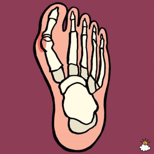 Healing and Preventing Bunions