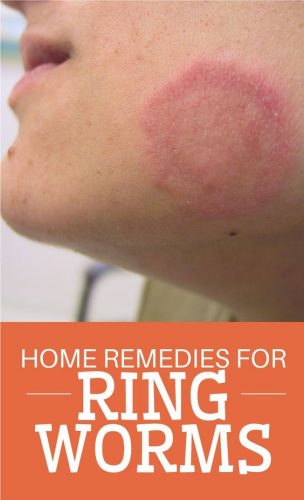 Healing Home Remedies for Ringworm
