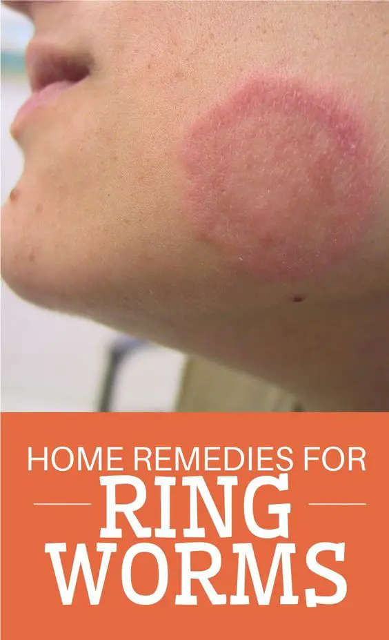 Healing Home Remedies for Ringworm