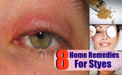 8 All Natural Remedies for Styes