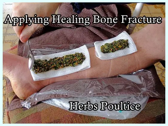 Applying Healing Bone Fracture Herbs Poultice