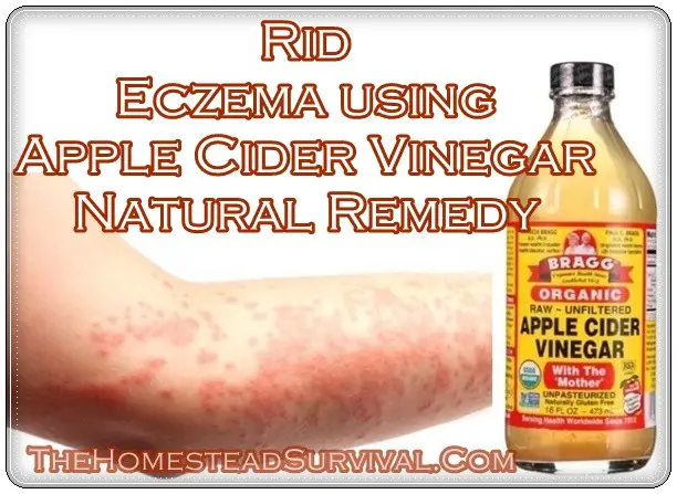 Rid Eczema using Apple Cider Vinegar Natural Remedy