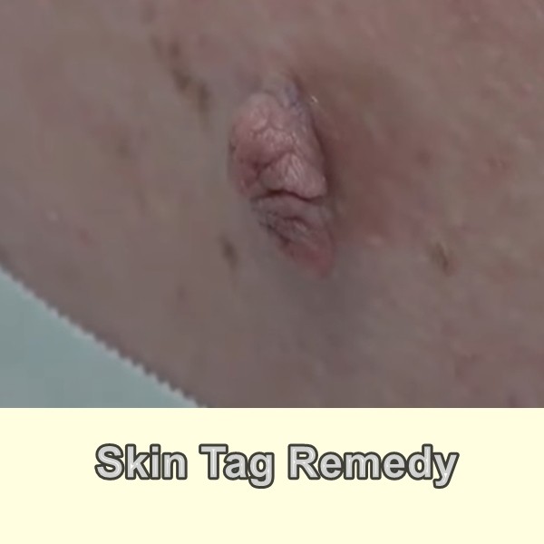 Skin Tag Remedy