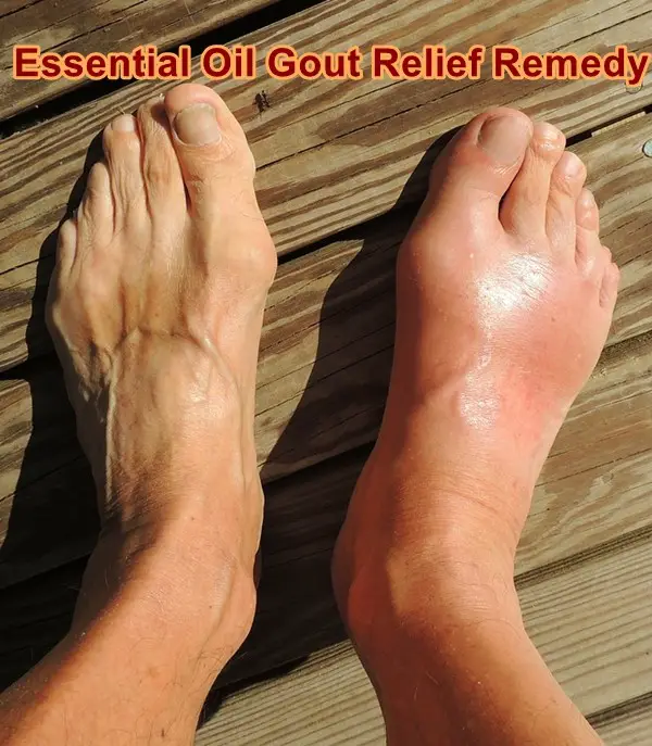 Essential Oil Gout Relief Remedy 