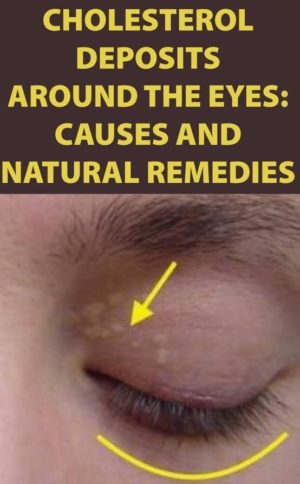 Home Remedies for Cholesterol Deposits Around the Eyes - The Homestead ...