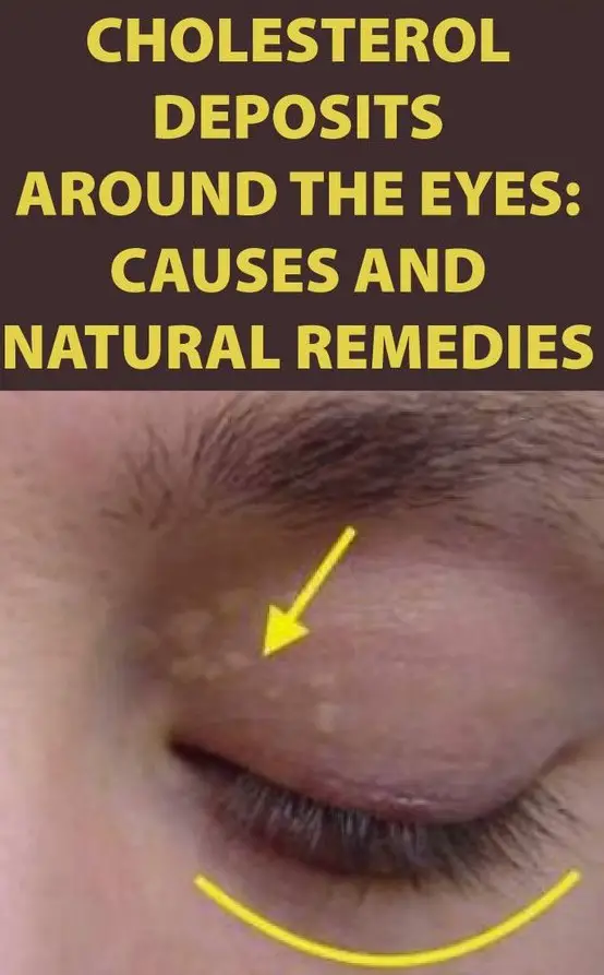 Home Remedies for Cholesterol Deposits Around Eyes