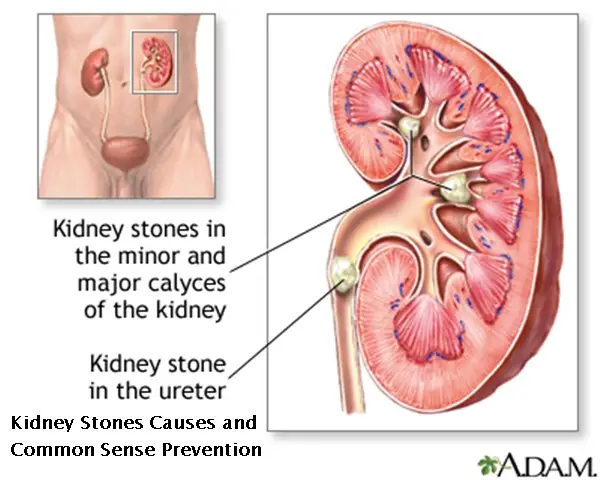 Kidney Stones Causes and Common Sense Prevention