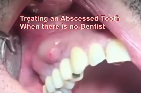 Treating an Abscessed Tooth When there is no Dentist