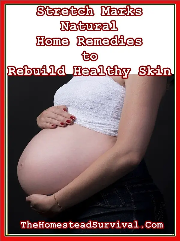 Stretch Marks Natural Home Remedies to Rebuild Healthy Skin
