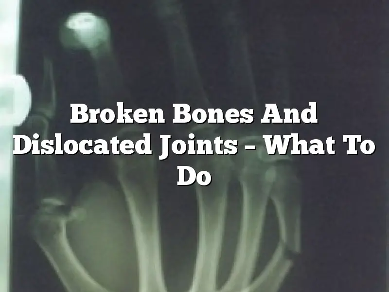 Broken Bones And Dislocated Joints – What To Do